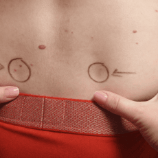 Iliosakralgelenk Blockaden erkennen und beheben